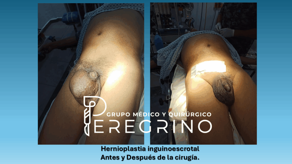 Resultado hernia